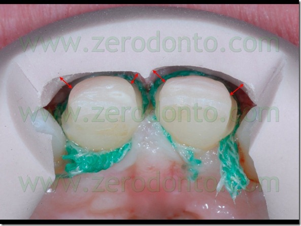 66 rifinitura preparazione smalto veneers