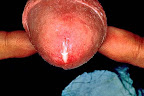 uretritis-por-clamidia.jpg