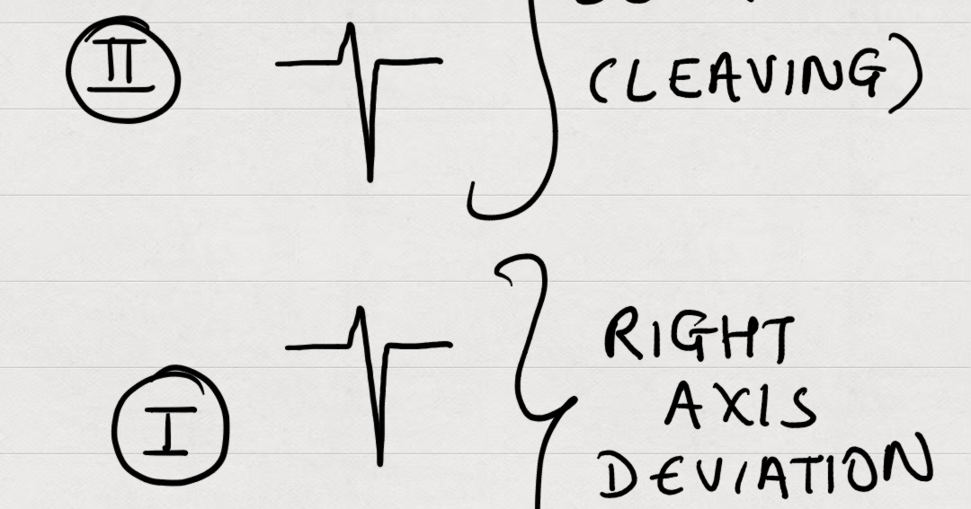 Medicowesome Evaluating axis from ECG (Mnemonic)