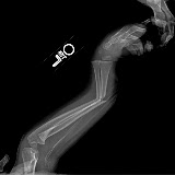 Pressly, Broken Arm