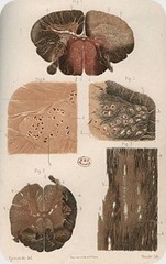 Sclerose Sclerose
