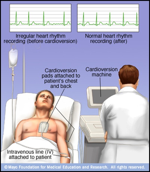 mcdc7_cardioversion