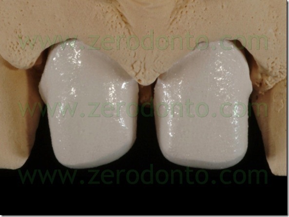 88 stratificazione ceramica faccette