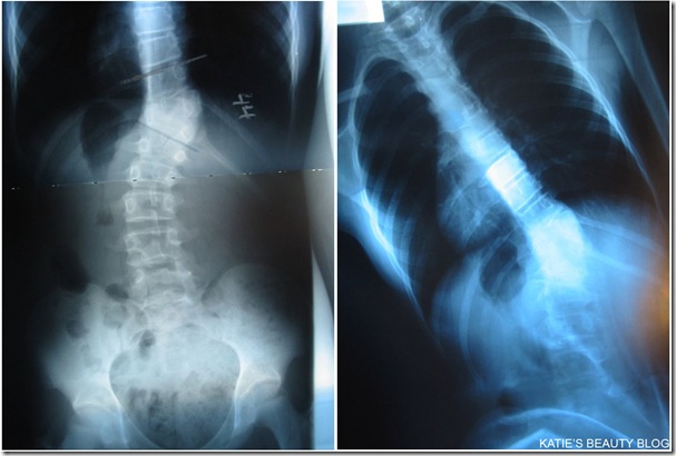 SCOLIOSIS 1 SCOLIOSIS 1
