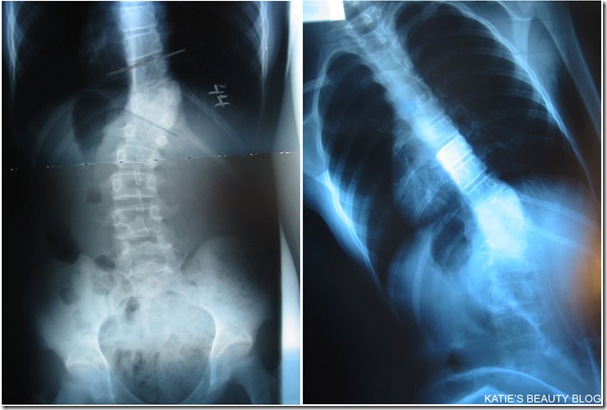 SCOLIOSIS 1