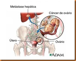 Câncer-de-ovário Câncer-de-ovário