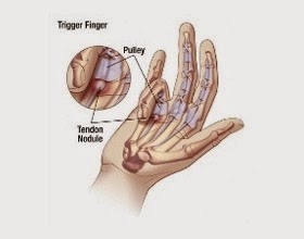 [Hand-Pain-Trigger-Finger%255B3%255D.jpg]