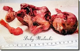 Truth of Abortion Truth of Abortion