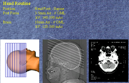TECHNIQUE CT SCAN OF BRAIN / CRANIUM - Radiology Imaging