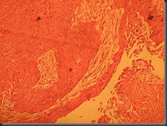 TCC- high resolution histology slide tsnaps TCC- high resolution histology slide tsnaps