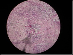 TB granuloma high resolution histology slide tsnaps TB granuloma high resolution histology slide tsnaps