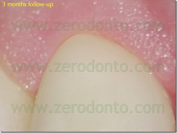 135 followup faccette ceramica