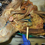 ureter_L.JPG