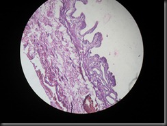 chronic cholecystitis high resolution histology slide tsnaps chronic cholecystitis high resolution histology slide tsnaps