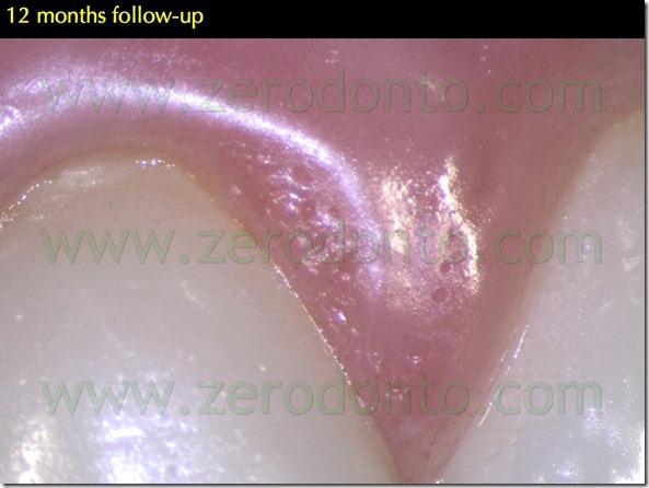 140 successo breve medio lungo termine veneers ceramica composito resina