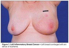 Breast Cancer