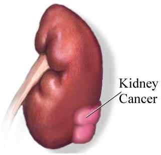 [kidney_cancer%255B3%255D.jpg]