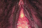 vagina-con-clamidia.jpg
