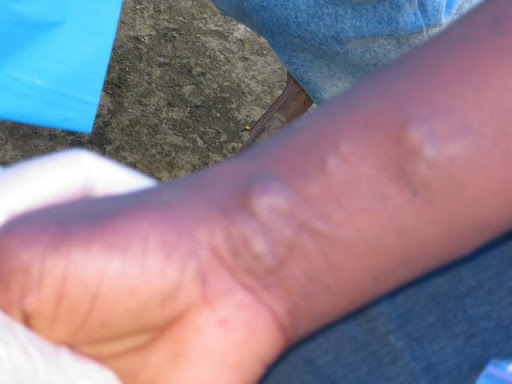 worms under skin