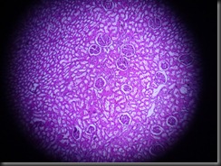 renal cell CA high resolution histology slide tsnaps renal cell CA high resolution histology slide tsnaps