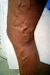 Varices Con Laser