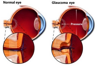 [glaucoma_eye10.jpg]
