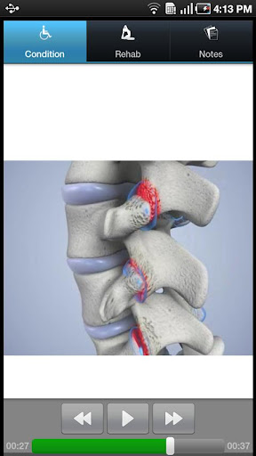 3DRX Facet Joint Syndrome