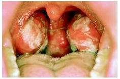 [mononucleosis[3].jpg]