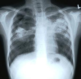 [tuberculosis-cough[4].jpg]