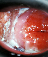 Vaginal_thrush_candidiasis
