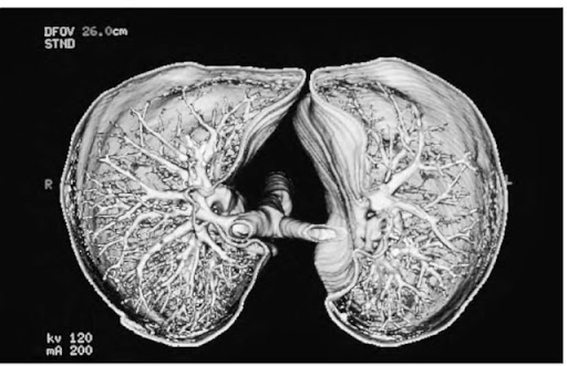 if the bronchioles in the lungs are dilated the anatomic dead space course hero