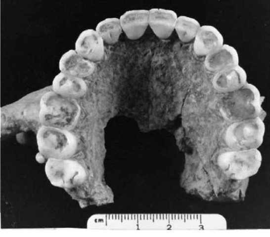 Human maxilla with complete permanent dentition showing severe wear of the anterior teeth. This is attributed to the habitual practice of using the mouth to hold oblects. Specimen is from a prehistoric archaeological site at Mahadaha, India. 