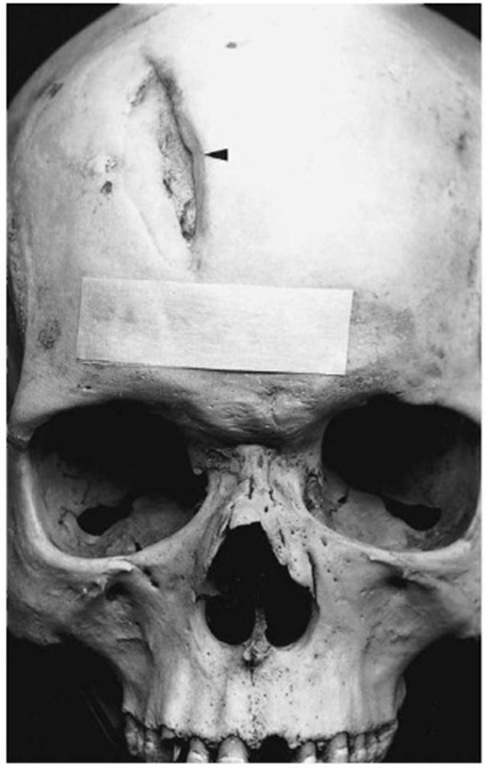 Healed sharp trauma on the skull (Pretoria skeletal collection). 