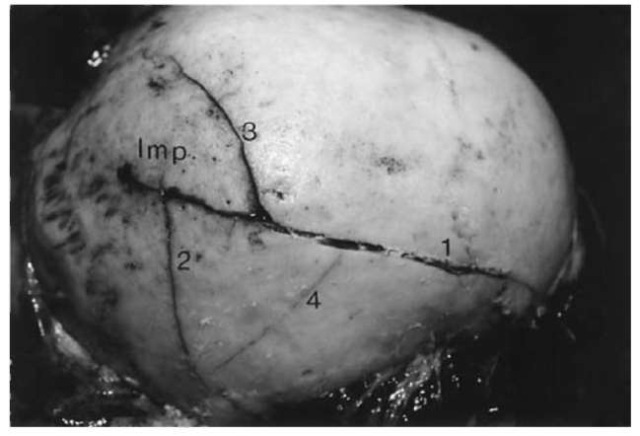 Right half of a cranial vault with two fractures (1, 2) radiating outward from the area of impact (Imp.) and in addition two incomplete circular fractures (3, 4).