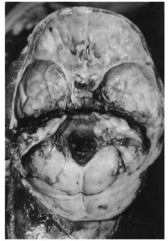 Transverse (side-to-side) 'hinge fracture' dividing the base of the skull into a front and rear half.