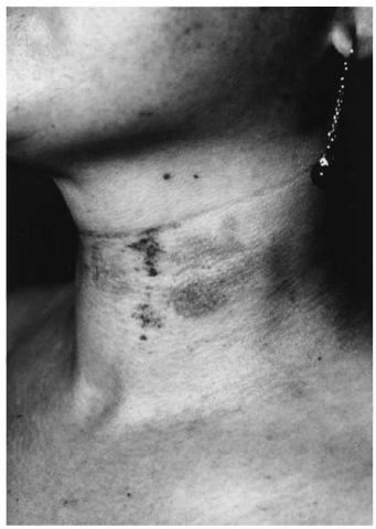 Neck of a rape victim with roundish bruises and scabbed abrasions from attempted manual strangulation.