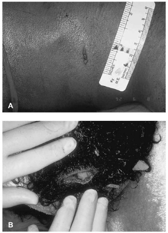 A, B Gunshot wounds of exit generally have irregular wound margins and will lack the physical evidence associated with entrance wound includingabrasion collars, soot, seared skin and 'tattooing'. Exit wounds associated with handgun ammunition are not consistently larger than the associated exit wound. These slit-like exit wounds have irregular margins.