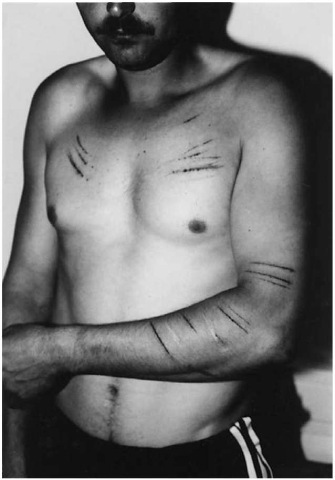  A 29-year-old right-handed man who inflicted cuts on his chest and left arm in order to gain the sympathy of his wife who had engaged in an extramarital affair with a lover. Note the symmetric arrangement of the chest wounds, their parallelism and uniformity. The whitish scars on the left forearm are due to former self-injurious episodes.