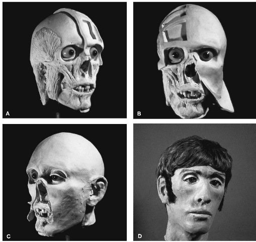  The morphoscopic method of facial reconstruction: (A) modeling the facial muscles and scalp strips; (B) adaptation of 'skin' covering; (C) modeling the ears and eyes; (D) the final, painted casting (sideburns added later);