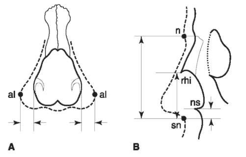  Relation of the external nose to the nasal aperture. (A) The average distance from the lateral margin of the nasal aperture to the ala (al) is 5 mm in the Caucasoid, 8 mm in the Negroid and 6.5 mm in the Japanese. (B) The position of the nasospinale (ns) corresponds to the lower seventh of the height of the external nose (n-sn).