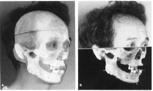  (A) Total mixing and (B) horizontal wipe images showing comparison between the digitized skull and face. The thickness of soft tissue of the anthropometric points and the distance between the anatomical landmarks are measured by means of pair-dots using the mouse.