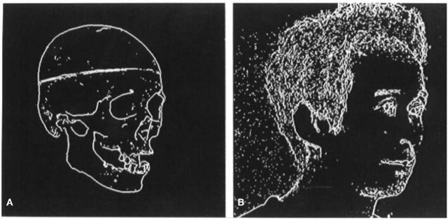 Thinning images extracted from (A) the digitized skull and (B) facial images. The forehead region of the thin line is selected=
