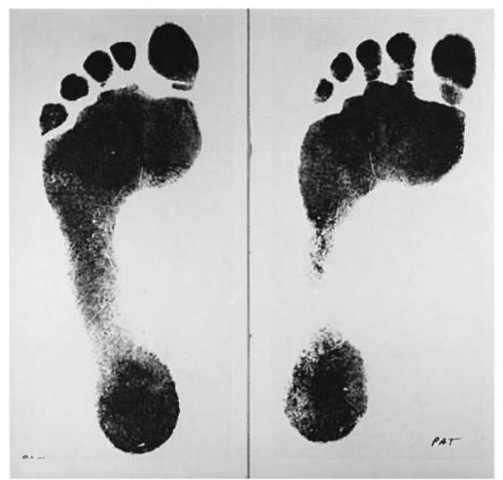 Inked barefoot impressions of the left feet of a pair of identical twins. This shows the differences between the placement of the toes, the presence of toe stems, and a high arch in one of the twins.
