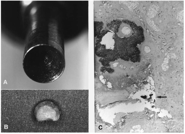 (A) Distal end of the captive-bolt in a Kerner type slaughtering gun; the steel bolt is conically grooved. (B) Punched-out piece of skin from the depth of the intracranial wound path ('skin imprimatum'). (C) Histological section of a skin imprimatum showing a bacterial colony and black powder residues (arrow). 