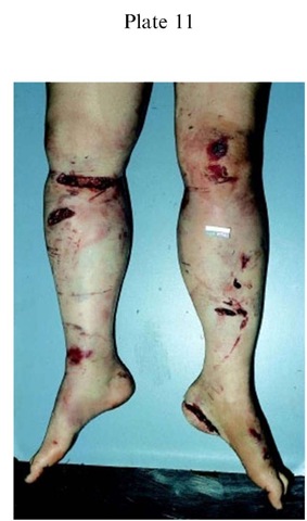 Plate 11 CAUSES OF DEATH/Traffic Deaths Bruising and abrasion indicating the level of contact with bumper bars.