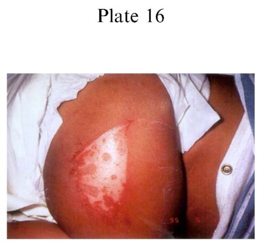 Plate 16 CLINICAL FORENSIC MEDICINE/Recognition of Pattern Injuries in Domestic Violence Victims Contact with the flat portion of a hot iron results in a unique thermal injury. The areas of sparing are from the steam holes.