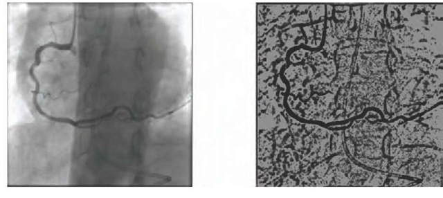 Morphological operators applied to an angiography 