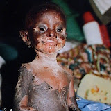  &ndash; Isha shortly after the fall into a cauldron of boiling water. Burns were all over her body. She died of the infection from the burns. .......© 2006 NHA Photos.
