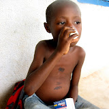  &ndash; Child with worms receiving medication from James thru Nazareth House. ©2007 NHA JMansaray photographer
