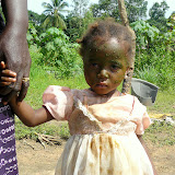  &ndash; This child has herbs on her face to control severe itching. We took cortizone into this village.......© 2007 NHA photos